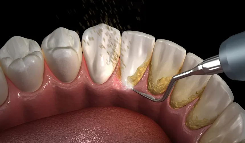 Kan ve demir ilacı kullanımında diş kararması nasıl önlenir?
